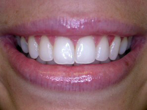 Even if you whiten your teeth you still want the result to look natural