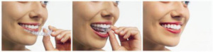Invisalign uses a series of clear removable aligners to gradually bring your teeth to a beautifully straight smile.