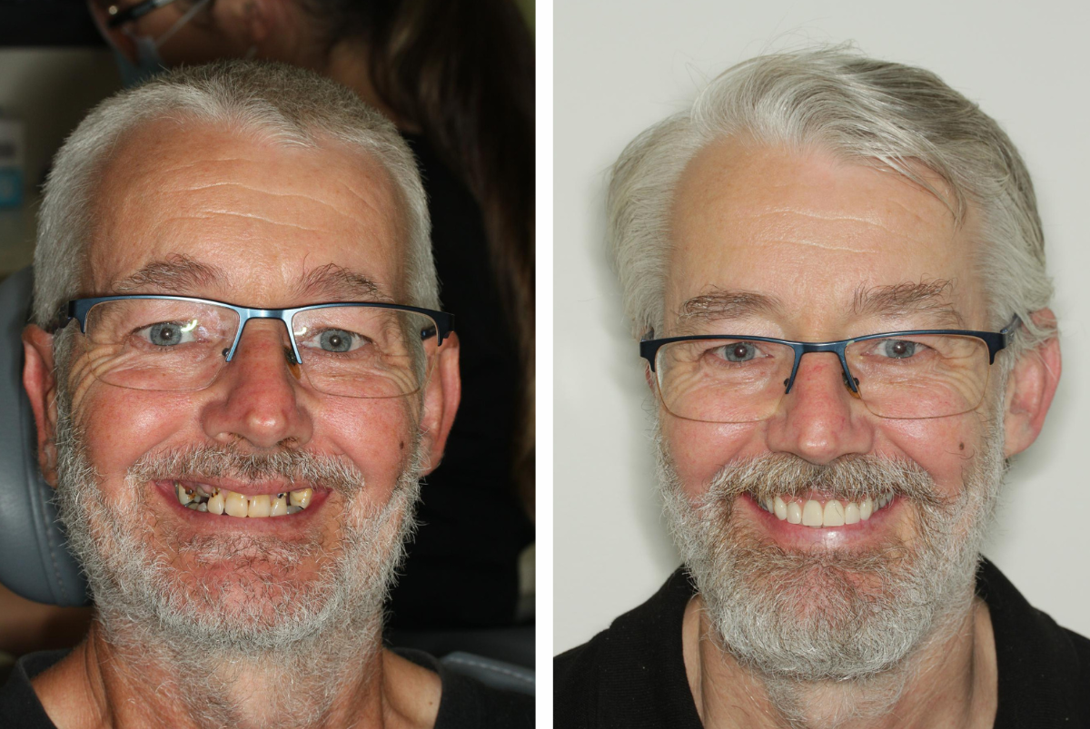 Dental Implant Brisbane Before and After Case 6