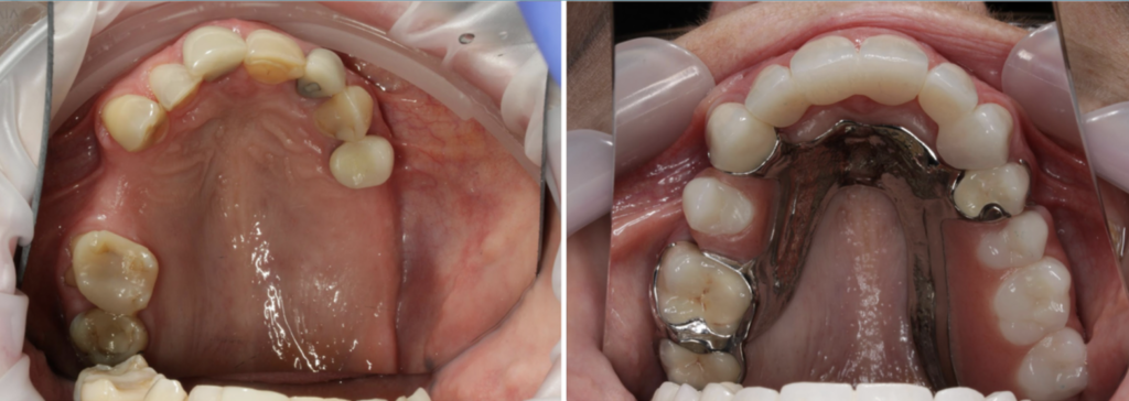 Case 1 - Before and After - Partial Denture