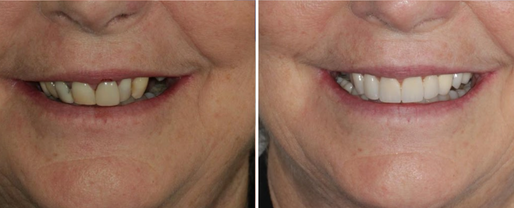Case 1 Before and After Crowns Bridges Brisbane