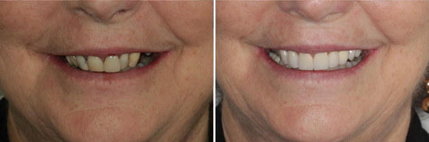 Case 1 Before and After Crowns Bridges Brisbane