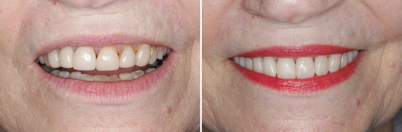 Case 1 - Before and After - Virtual Smile Design
