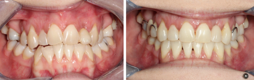 Case 1 - Invisalign - Before and After
