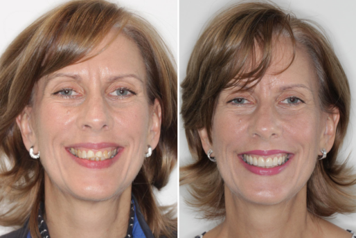 Case 1 - Veneers - Before and After
