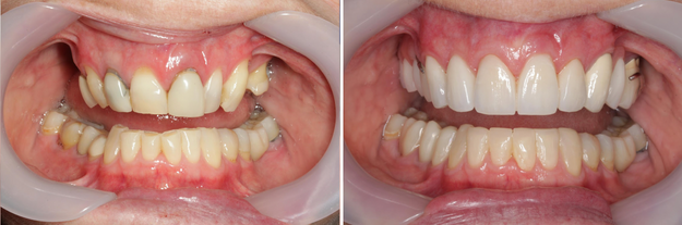 Case 2 - Before and After Crowns and Bridges Brisbane