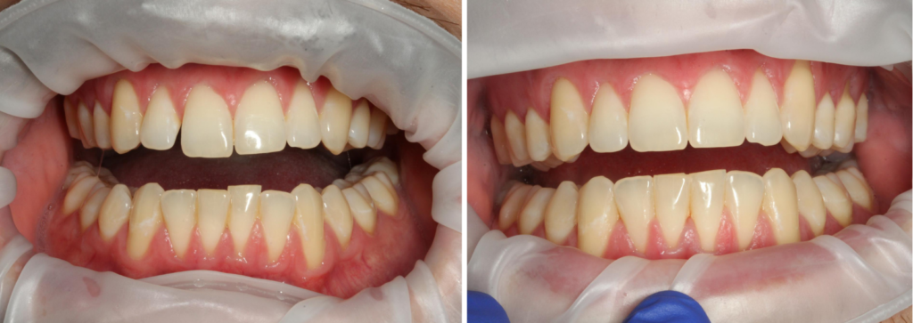Case 2 - Before and After - Ortho