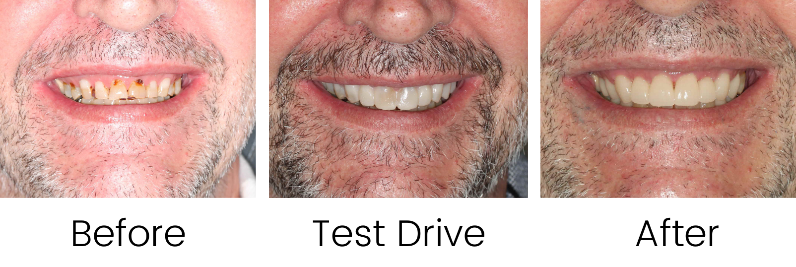 Case 2 - Before and After - Virtual Smile esign -