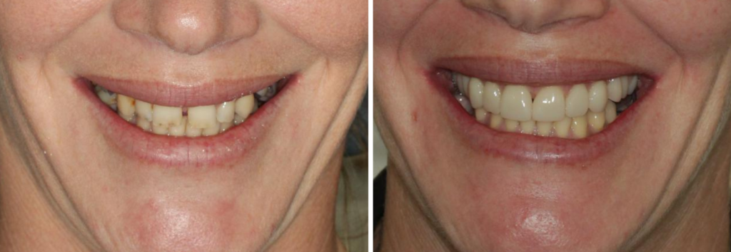 Case 2 - Before and after - Partial Denture