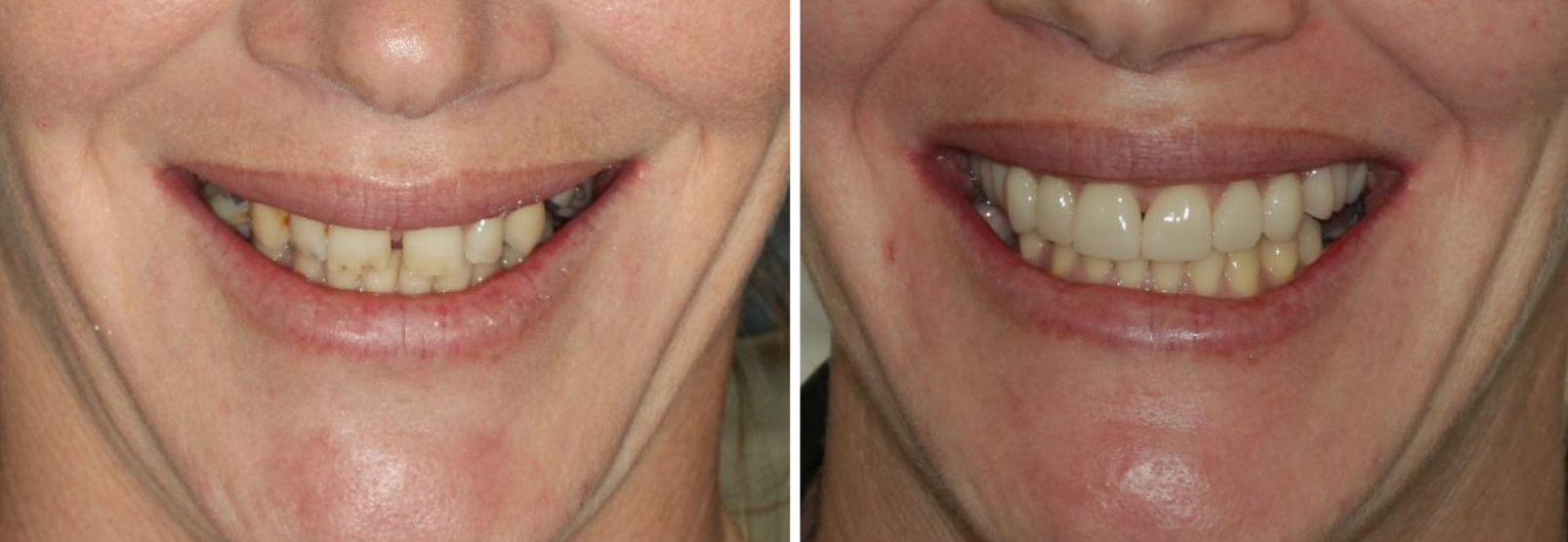 Case 2 - Before and after - Partial Denture