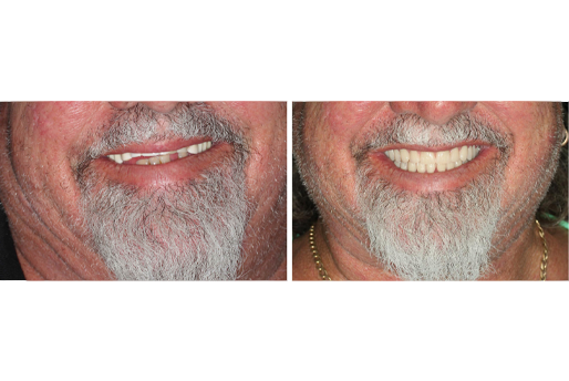 Case 2 Before and after - Snap-in Denture