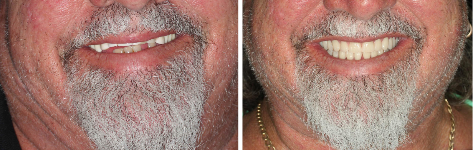 Case 2 Before and after - Snap-in Denture