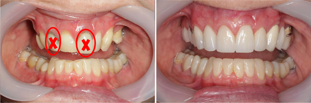Case 3 - Before and After Crowns and Bridges Brisbane