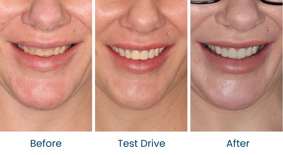 Case 3 - Before and After - Virtual Smile Design