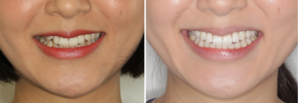 Case 3 - Invisalign - Before and After