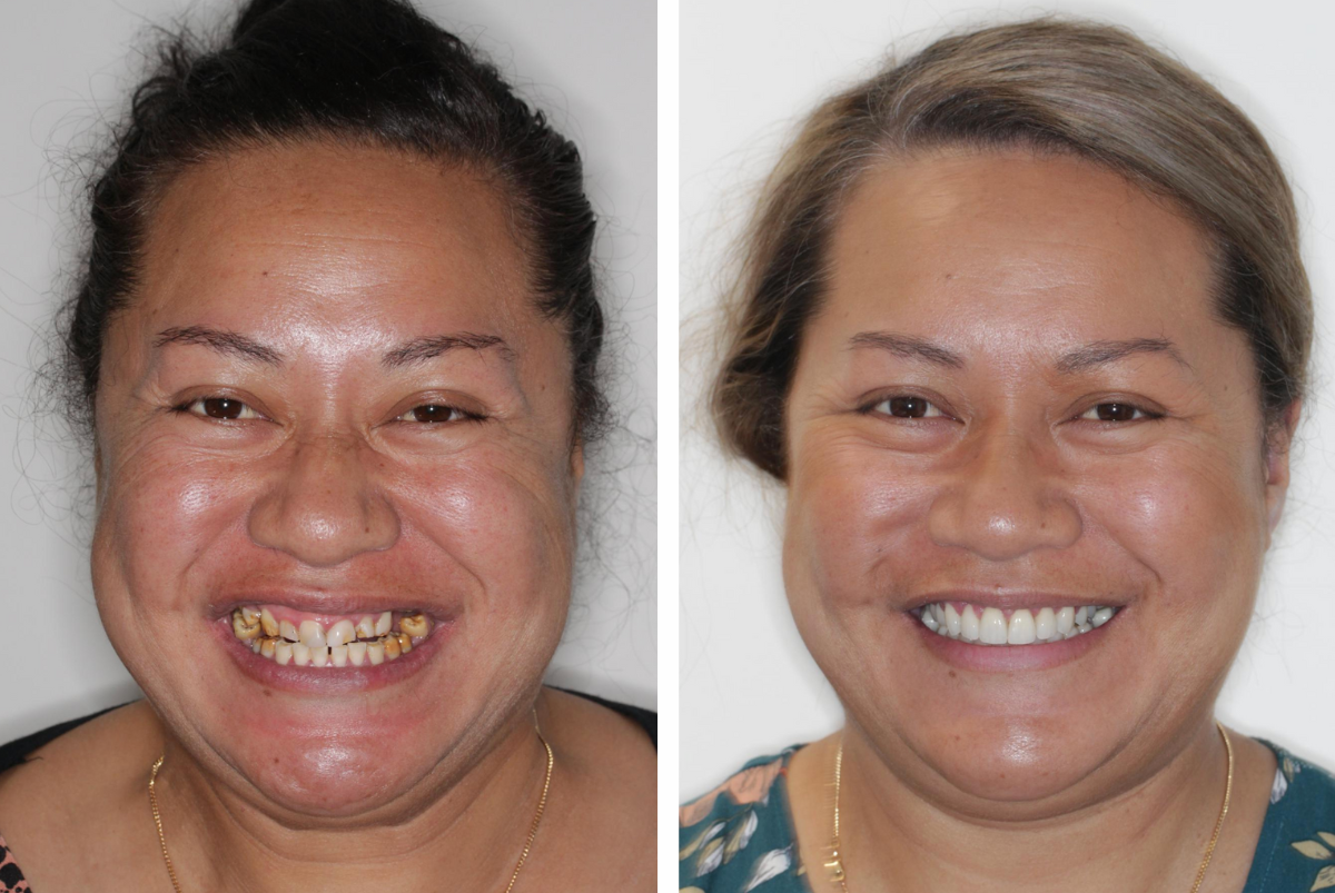 Case 3 - Veneers - Before and After