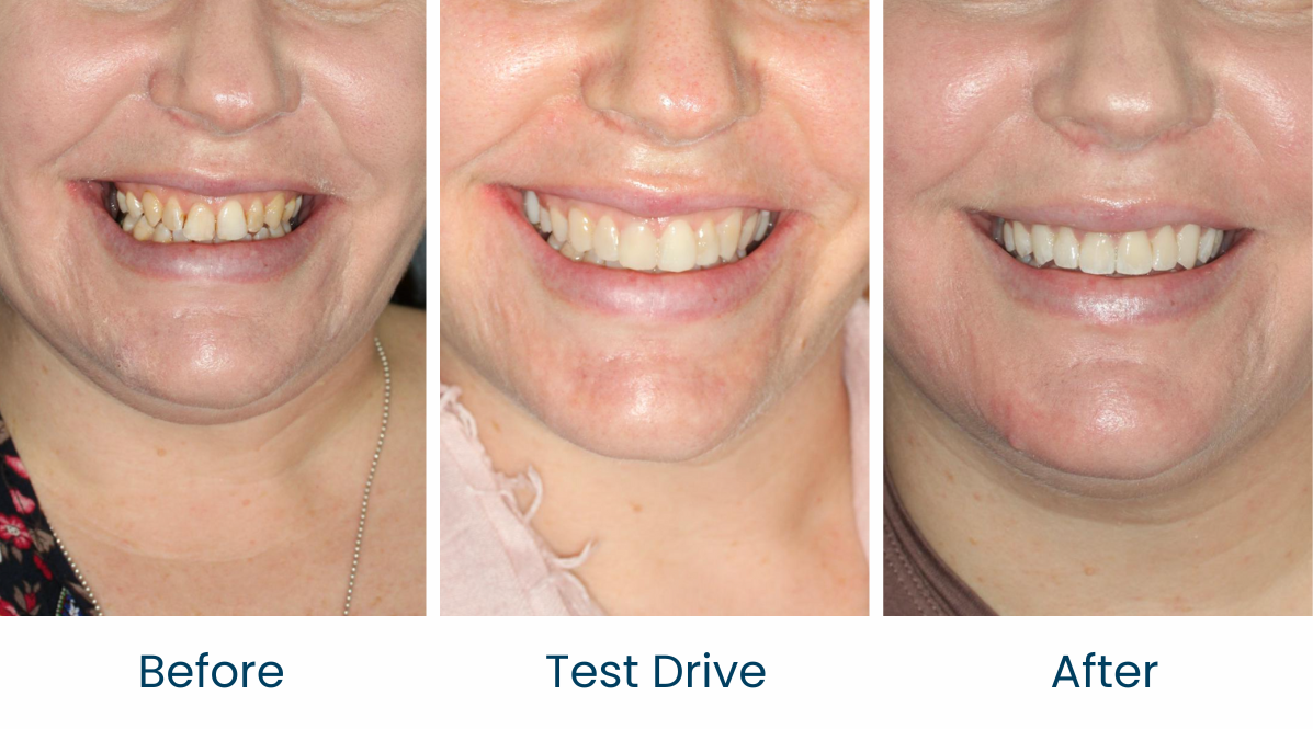Case 4 - Before and After - Virtual Smile Design