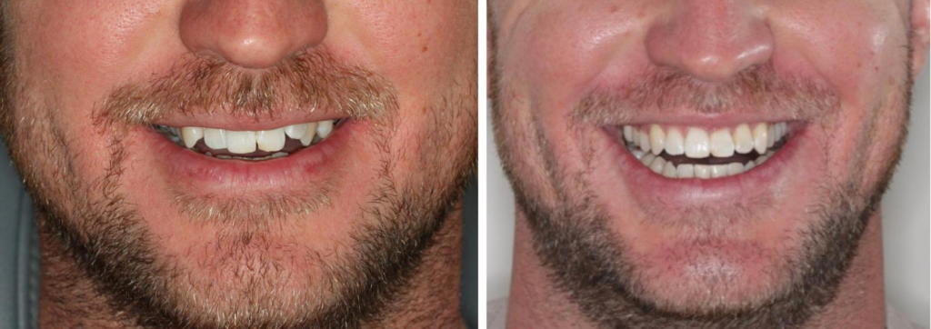 Case 4 - Invisalign - Before and After