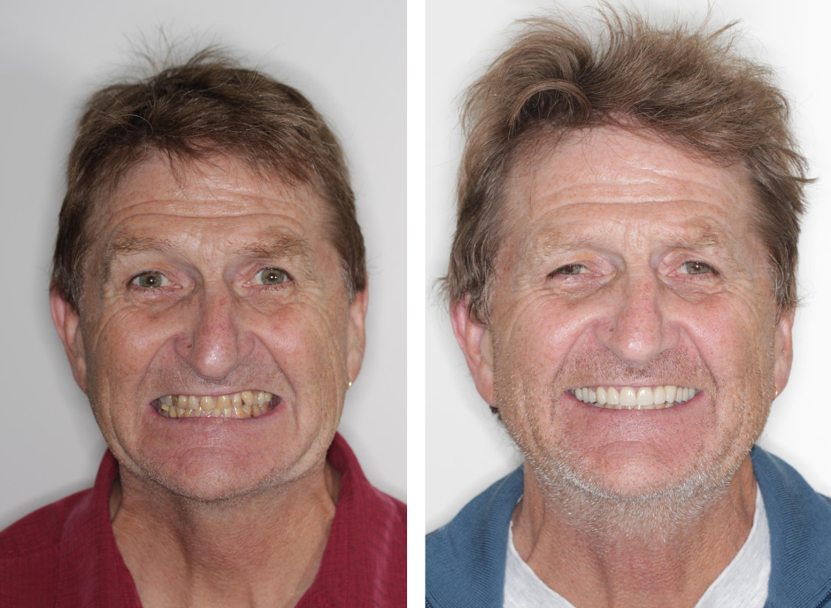 Case 4 - Veneers - Before and After