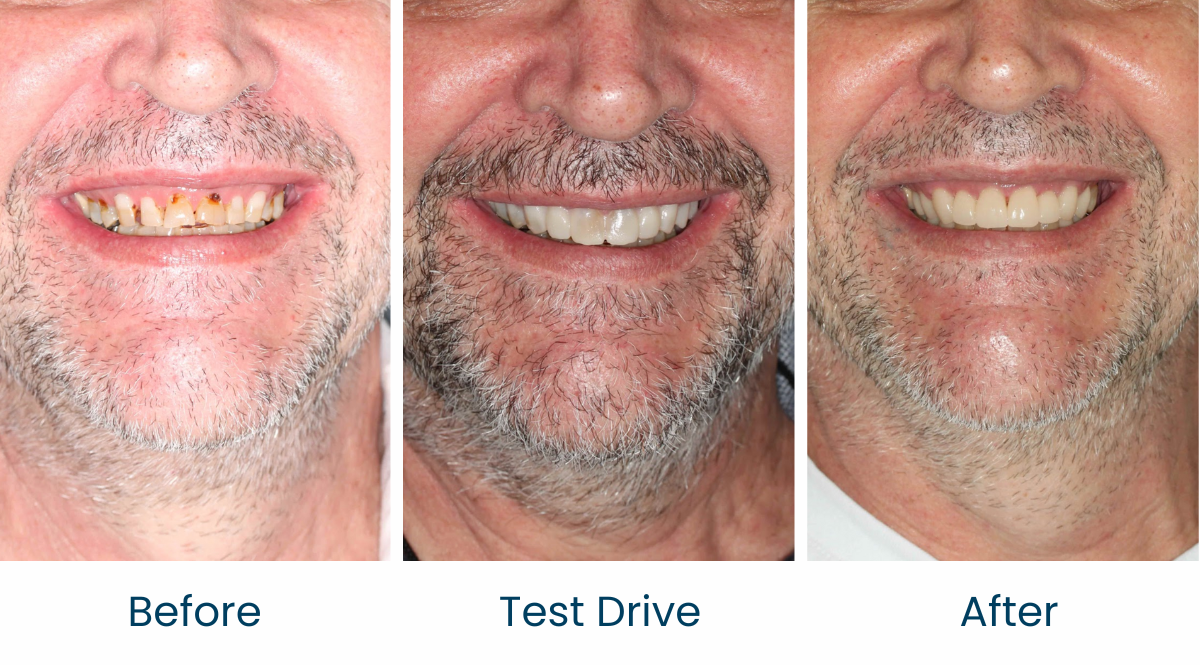 Case 5 - Before and After - Virtual Smile Design