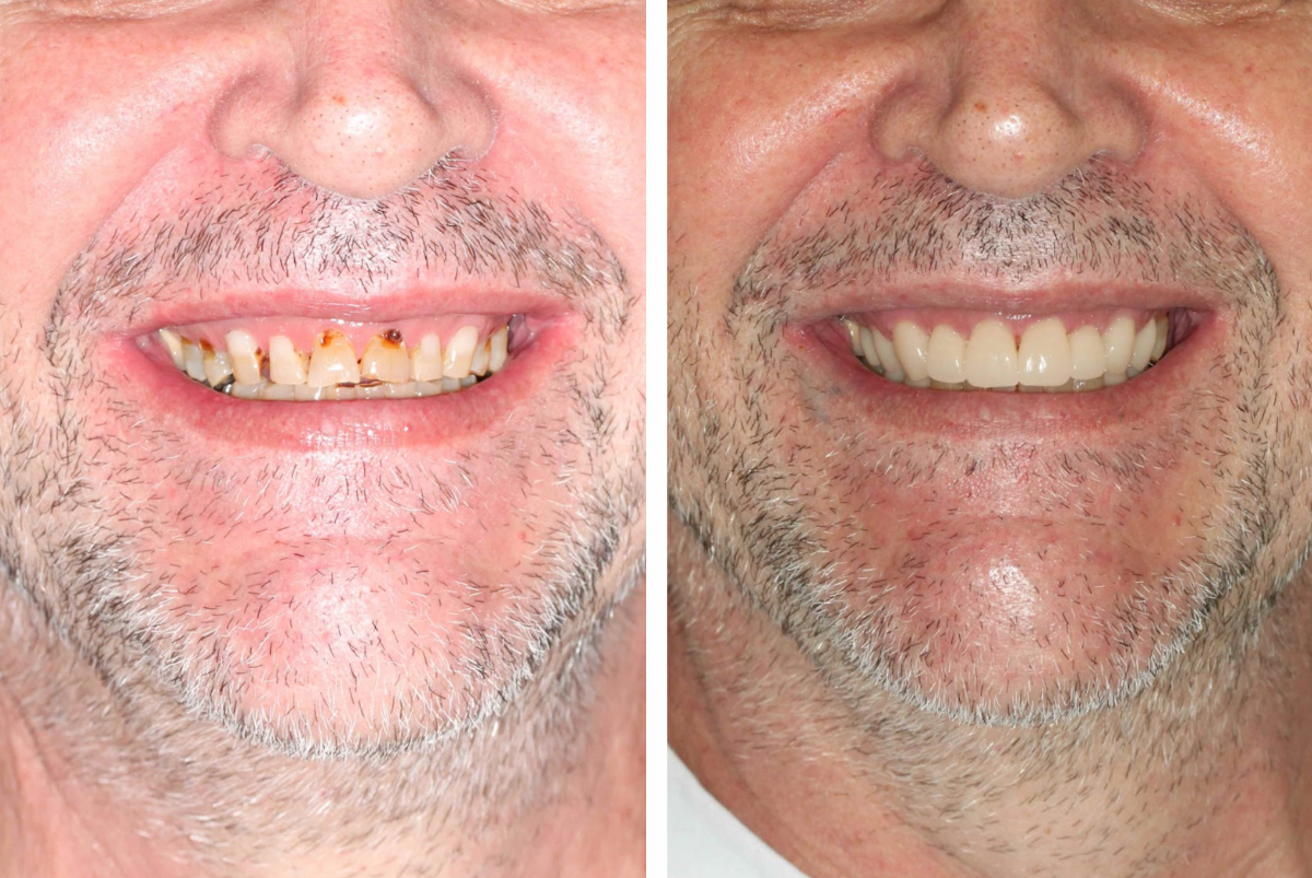 Case 5 - Veneers - Before and After