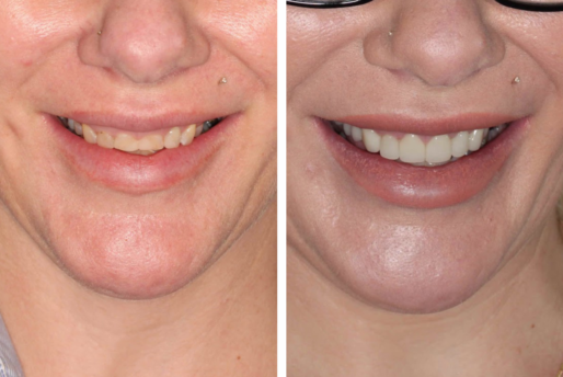 Case 6 - Veneers - Before and After