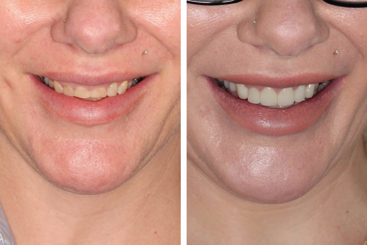 Case 6 - Veneers - Before and After