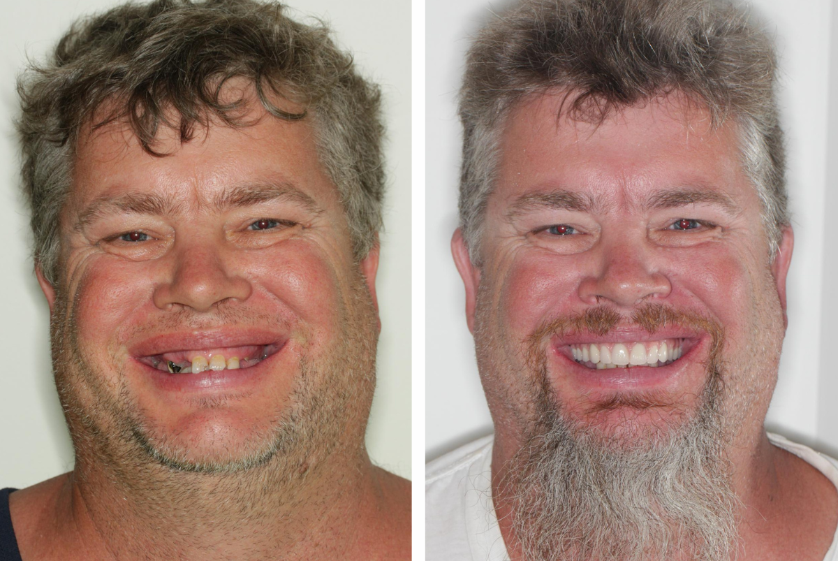 Dental Implant Brisbane Before and After Case 3