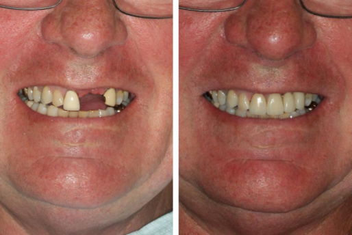 Dental Implant Brisbane Before and After Case 4