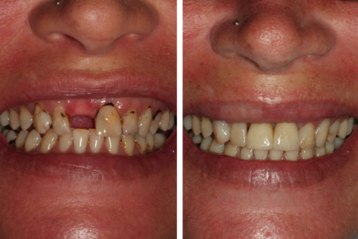 Dental Implant Brisbane Before and After Case 5