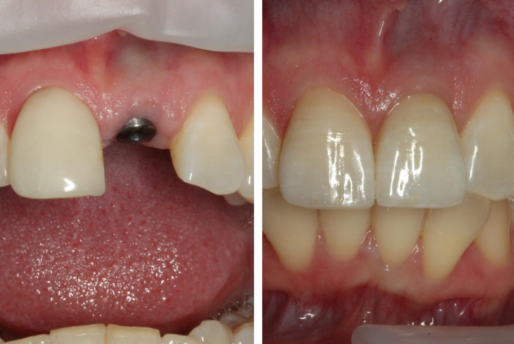 Dental Implant Brisbane Before and After Case 1