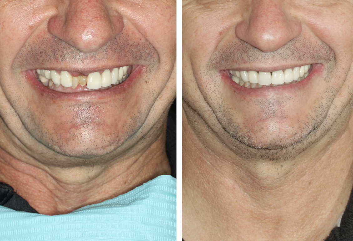 Dental Implant Brisbane Before and After Case 2