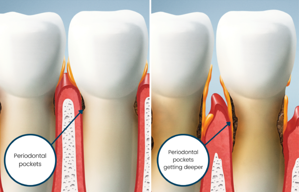 Gum Disease Periodontal Illustration