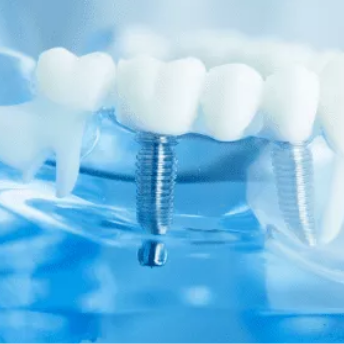 dental implants service Brisbane