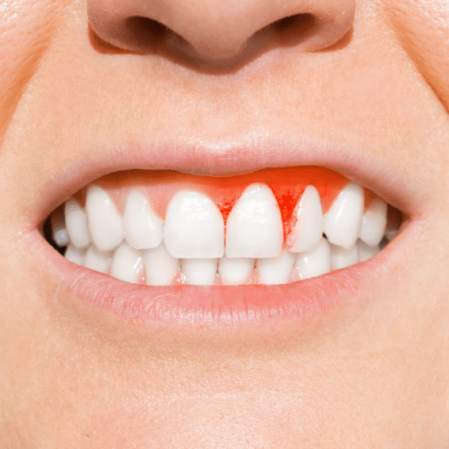 Gum disease treatment in Brisbane