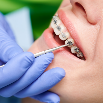 orthodontic braces image
