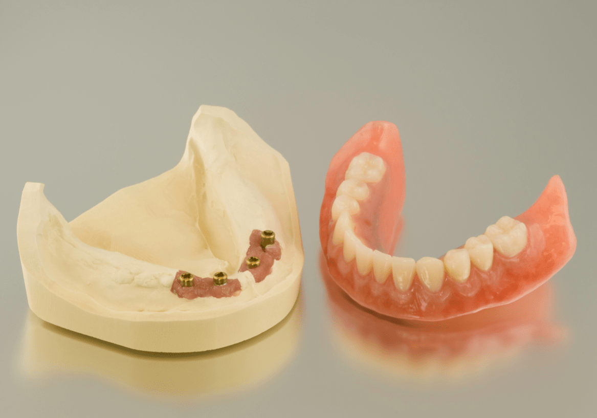 Snap-in dentures in Brisbane