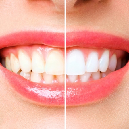Teeth whitening in Brisbane