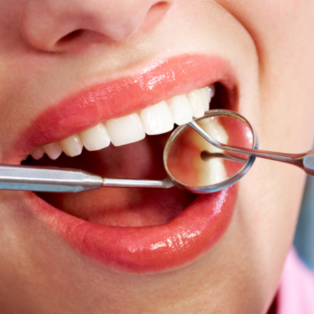 Discreet Dental Fillings: Tooth-Coloured Fillings Brisbane